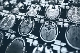Ressonância cerebral pode prever ritmo de envelhecimento do corpo