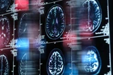 Dois remédios contra o câncer mostram potencial para tratar Alzheimer