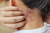 Psoríase: dermatologista recomenda 6 passos para aliviar coceiras