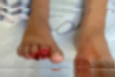 Criança de 9 anos tem dedos dos pés arrancados após ataque de piranhas
