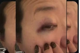 Vídeo. Corredora fica com olho roxo após agressão no Ibirapuera