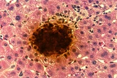1º transplante com terapia inovadora para diabetes é realizado nos EUA