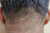 Acne no couro cabeludo: especialista explica como tratar a condição