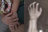 Professora é demitida por luxar braço de criança em creche no litoral