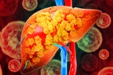 Gordura no fígado: saiba quais são os sintomas da esteatose hepática