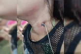 Homem foge após cravar prego no pescoço da namorada