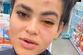 Mosquinha de banheiro entra no olho de jovem e causa reação grave