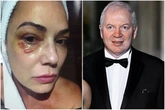 Luiza Brunet pede indenização de R$ 1 milhão a ex-marido por agressão
