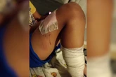 Pit-bull deixa três crianças feridas em condomínio no interior de SP
