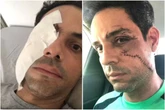 Empresário é agredido com copo de vidro e leva 62 pontos no rosto