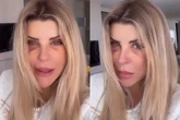 Iris Stefanelli causa comoção ao surgir com os olhos roxos: “Bateram?”