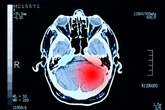 Desordem em anéis de DNA revela pistas sobre câncer cerebral agressivo