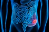 Médicos apontam 6 medidas para reduzir risco de câncer de intestino