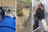 Professora cai em buraco após descer do ônibus e passa por cirurgia