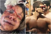 Mulher que levou 60 socos do namorado: “Ele disse que iria me matar”