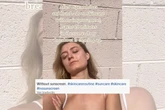 Trend “Nosunscreen”, em alta na gen Z, pode causar até câncer de pele