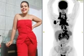 Jovem conta sinais que ignorou de câncer que a “esmagava por dentro”