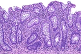 Doenças inflamatórias intestinais não são mais raras e exigem atenção