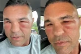 Vitor Belfort ficou “irreconhecível” após procedimento; entenda riscos