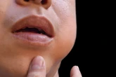 Caxumba desce? Doença pode afetar a fertilidade em homens e mulheres