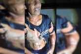 Mulher é vítima de feminicídio: “Ele tacou álcool e fogo em mim”