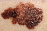 Vírus da herpes modificado reduz melanoma avançado em ensaio clínico