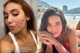 Vanessa Lopes diz que ficou com medo de perder contratos por ter acne