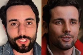 Rinoplastia de Matteus Amaral: especialista explica avanços e cuidados