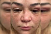 Advogada presa por agressão se defende e mostra fotos de lesões: veja