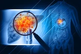 Fibrose hepática: como reverter quadro grave no fígado, segundo médica