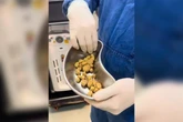 Médico retira 35 pedras da bexiga de homem viciado em refrigerante