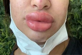 Mulher fica com rosto deformado após procedimento que custou R$ 1 mil