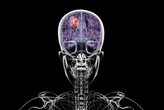 Glioblastoma: câncer cerebral grave corrói o crânio, diz estudo