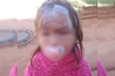 Criança de 3 anos leva 27 pontos no rosto ao ser atacada por cachorro