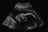 DF: adolescente asfixia e joga bebê prematuro no lixo ao forçar aborto