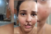 Sem avisar, marido manda matar chow-chow que arrancou lábio de mulher
