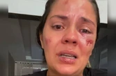 “Desesperador”, diz mulher que sofreu acidente em parque aquático