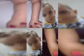 Mãe denúncia creche após filho chegar em casa com machucados. Veja