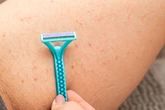 Foliculite tem solução: médico dá dicas para prevenir e tratar
