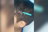 Menino tem lápis fincado na cabeça após agressão de colega em escola