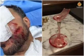 Veja como ficou o rosto de funcionário agredido com taça por advogado