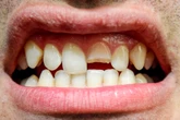 Quebrou o dente? Especialista explica como agir nessa situação