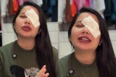 Influencer sofre hemorragia ocular após usar lentes vencidas em trend