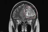 Com dor de cabeça frequente, mulher descobre tumor cerebral de 15 anos