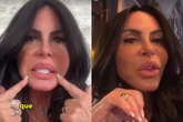 Gretchen remove PMMA dos lábios: “Agora está perfeita”