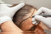 Transplante capilar feminino: veja para quem é indicado e como fazer