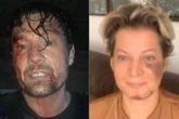 Ator aparece ferido e debocha de Joice Hasselmann: “Sofri um atentado”