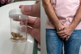 Homem fica com várias pedras de sujeira após 30 anos sem lavar o pênis