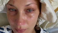Bella Hadid posta delle foto dall’ospedale dove è ricoverata per la malattia di Lyme