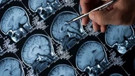 Alzheimer, 'ripulire' il cervello per contrastare la malattia